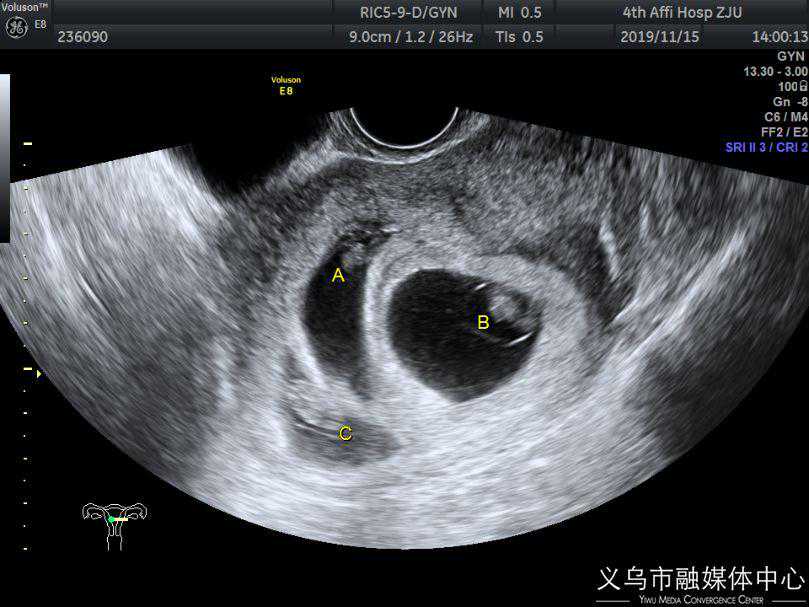 厉害了！义乌首例“减胎手术”成功，三胞胎变双胞胎！